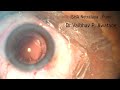 Phaco , Stop & Chop , Triphobic IOL , 25/05/26