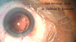 Phaco , Stop &amp; Chop , Triphobic IOL , 25/05/26