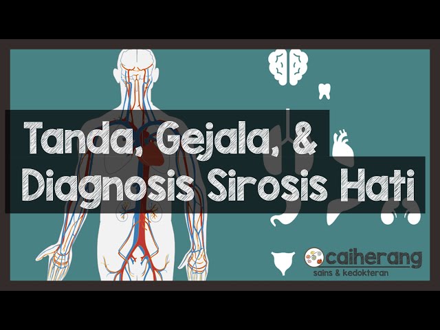 Tanda, Gejala, dan Diagnosis Sirosis Hati (Deteksi Sirosis Hati dan Gagal Hati) class=