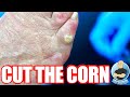 PAINFUL CORN FINALLY REMOVED AFTER QUARANTINE LIFTED ON FOOT CLINIC