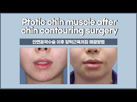 Video: Genioplastika (Chin Surgery): Druhy, Komplikácie A Výhľad