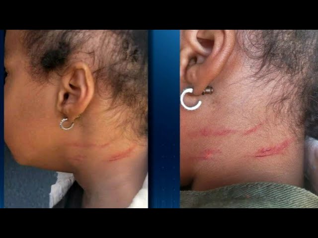 Local grandmother claims granddaughter received scratches at day care | WSB-TV class=