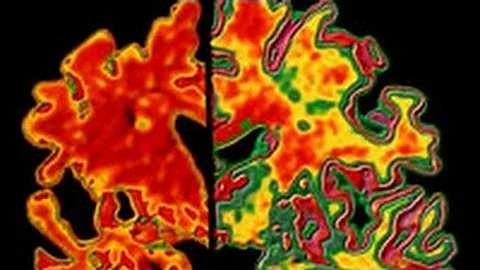 Alzheimer's Test Can Detect Disease Decades in Advance