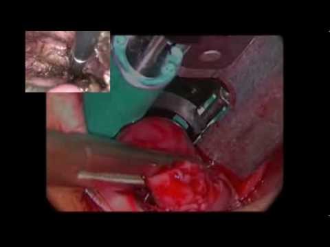 Combined Transanal And Laparoscopic Excision For Rectal Endometriosis Nodules
