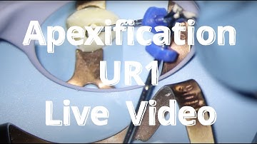 Apexification immature tooth - LIVE VIDEO | I ❤️ the pulp