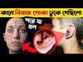 কানে বিষাক্ত পোকা ঢুকে গেল পরে যা হল | Remove Insect from Ear, Animals | Treatment for Insect in Ear