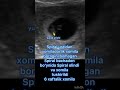 Spiral ustidan xomiladorlik 6 xaftalik xomila