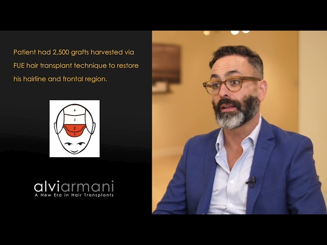 FUE Hair Transplant Experience - Why I Chose Alvi Armani to do my Hair Transplant