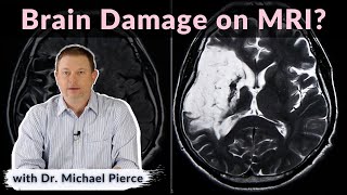 Will Brain Damage Show On Mri?
