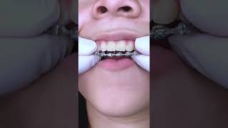 Satisfying braces removal!  Reminder to brush your teeth well 😊😷 TheBracesDoc