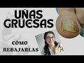 Cmo rebajar las uas de los pies uas gruesas por hongos psoriasis ancianos