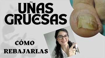 ¿Cómo se llaman las uñas gruesas?