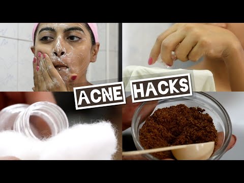 Acne -  Acne Hacks & How to Treat Acne Prone Skin |  Face Wash Tips