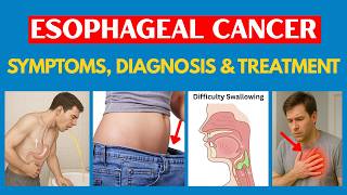 Esophageal Cancer Symptoms (Most People Ignore) - Oesophageal/Food Pipe Cancer Diagnosis & Treatment