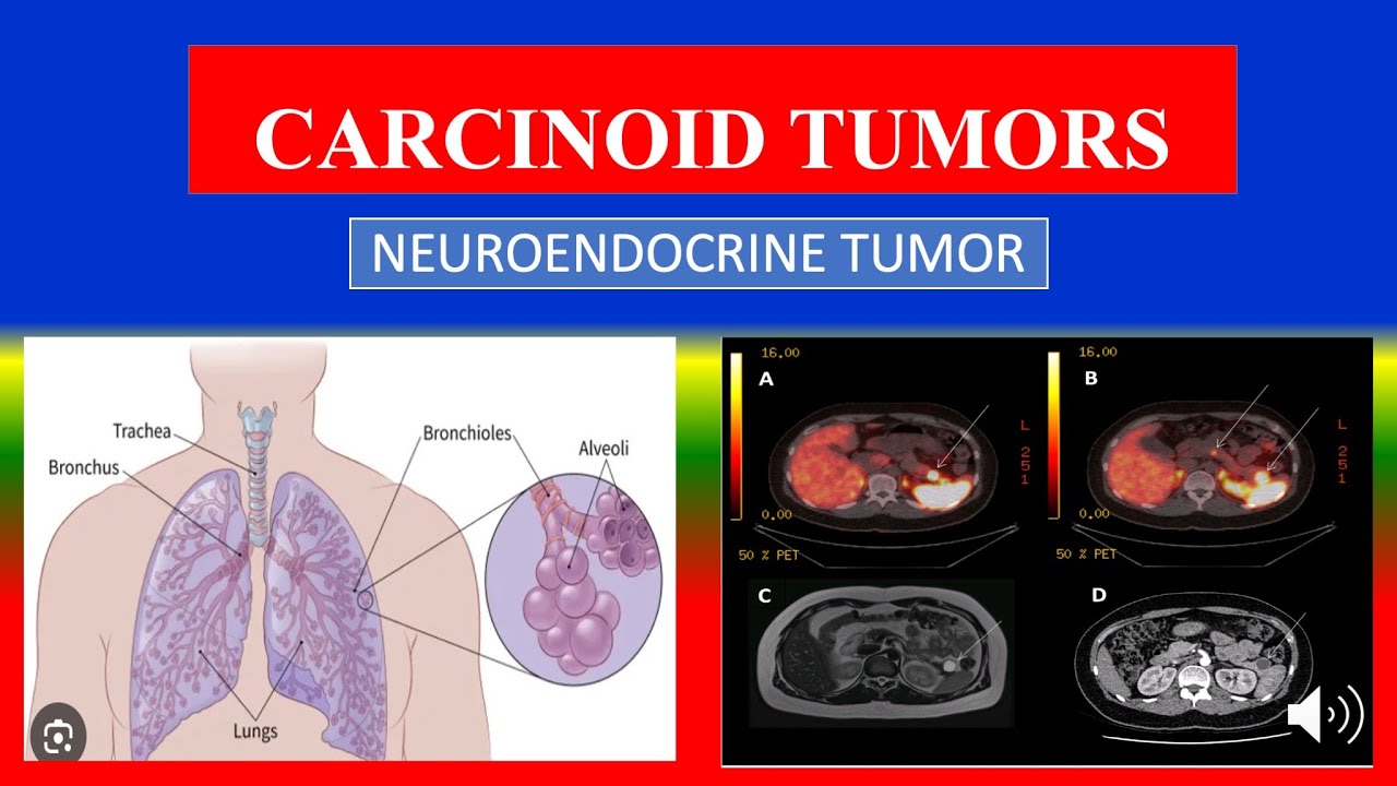 CARCINOID TUMORS - Definition, types, causes, pathophysiology, symptoms ...