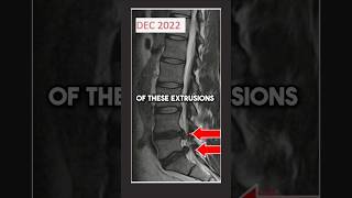Double Lumbar disc extrusion resorption #discextrusion