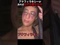アナフィラキシーがあれば必ず必要なもの