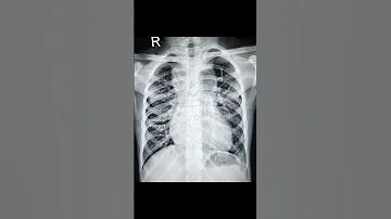 Spot Diagnosis CXR Part 1 Shorts Cxr Medical Snippet 