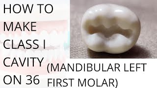 Class 1 Cavity Preparation on 36 , Mandibular Left First Molar (Bat shape Cavity)