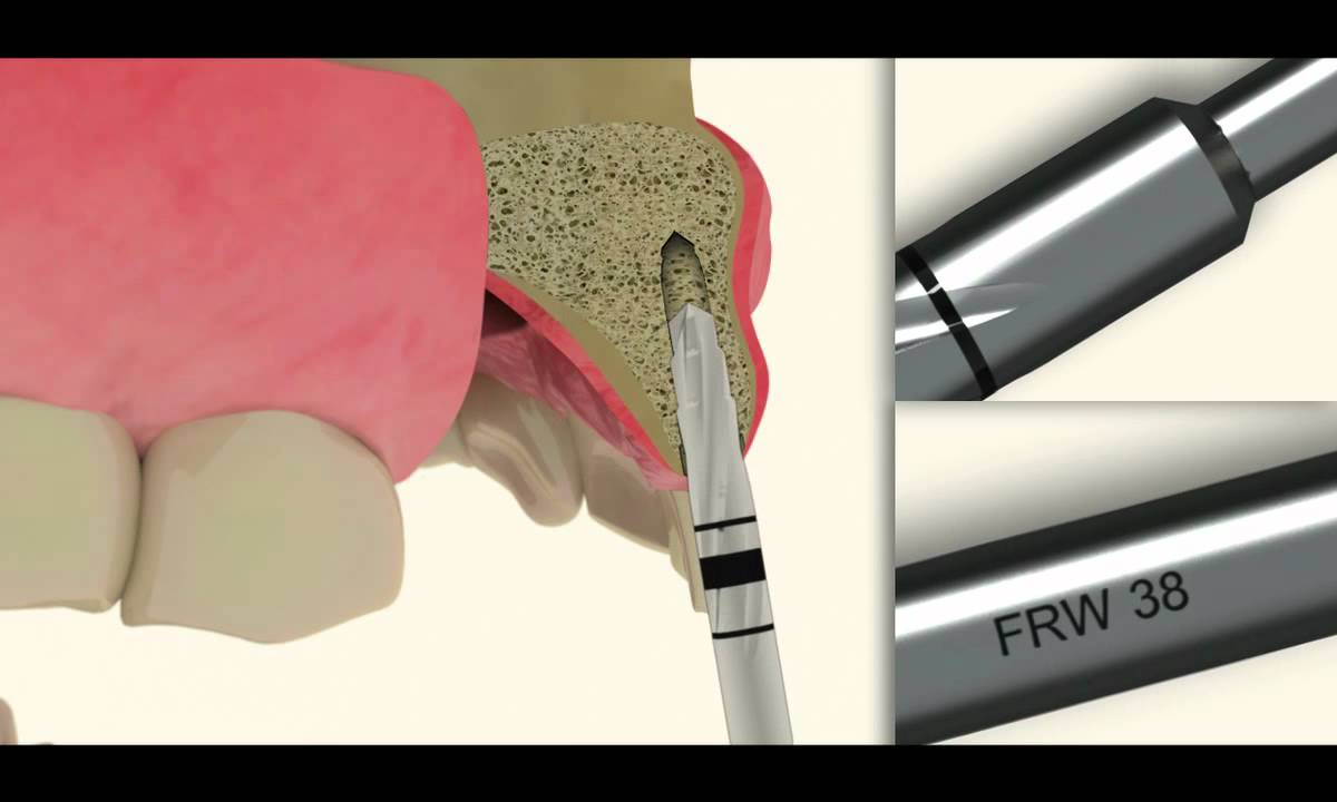 Strong Sw Sequencia Protética em 3D do implante Strong SW - YouTube