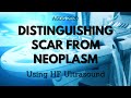 ASDS 2020: Distinguishing Scar from Neoplasm Using HF Ultrasound