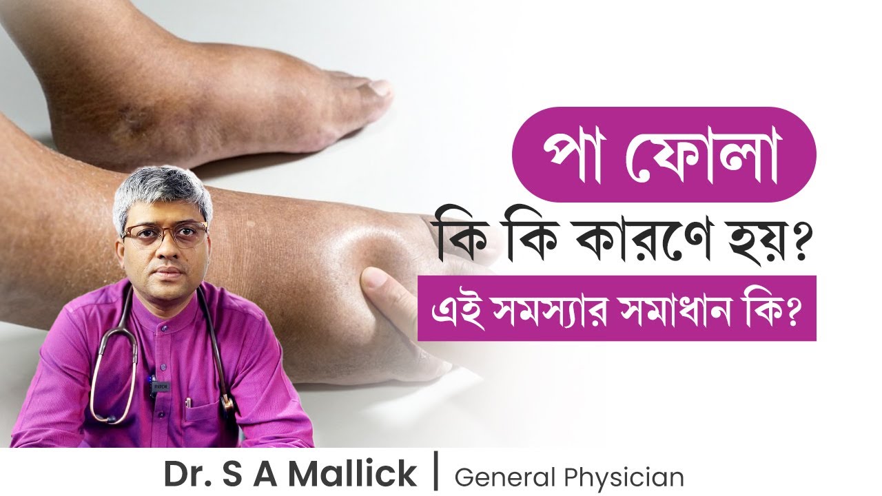 কি কি কারণে পা ফুলে যায়? পা ফুলে গেলে কি করণীয়? Causes & Treatment of Edema - Dr. S A Mallick