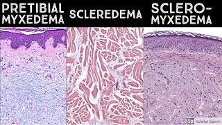 Pretibial Myxedema vs Scleredema vs Scleromyxedema - Dermatopathology 