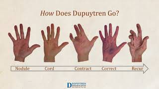 Dupuytren Awareness