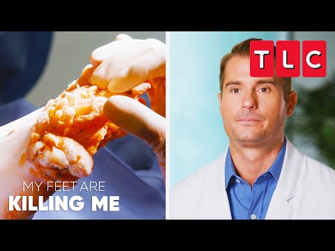 Worst Foot Growths | My Feet Are Killing Me | TLC