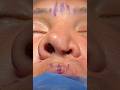Rinoplastia - Valvuloplastia - Dr Luis Jaimes