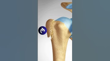 Proximal Humeral Fracture of the Shoulder - #4K #3D #animation