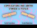 Complications phalloplastie no urtre fistule  stnose  ftm transgenre franais  crazyden 