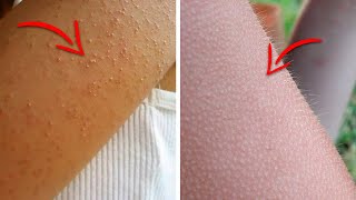 Do You Have Those Tiny Bumps on Your Arms? Here's What They Mean