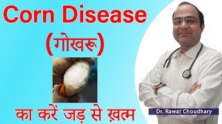 Corn Disease | गोखरू | गट्ठा | Foot Corn Best Treatment | Best Homeopathic Doctor screenshot 4