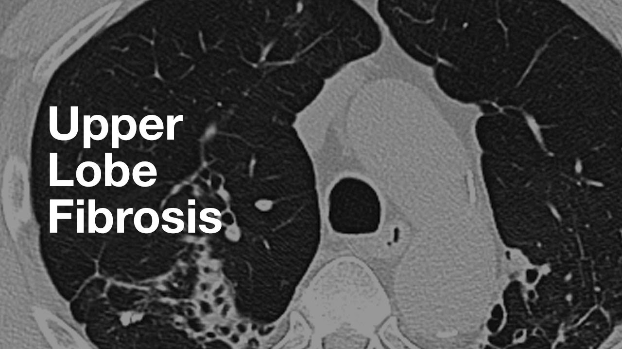 Lung rads 2. Lung rads 3. Lung rads. Luftsichel sign upperlobe Collapse.