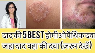 दाद,खाज,खुज़ली का जड़से इलाज-Homeopathy For Ringworm?Tinea? -Dr.rukmani Choudhary Homeopathic Clinic