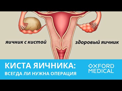 КИСТА ЯИЧНИКА: всегда ли нужна операция