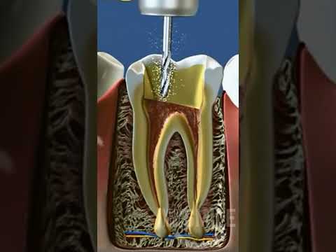 Video: Dental Tandbryd: Braces og Root Canals er ikke længere en nyhed