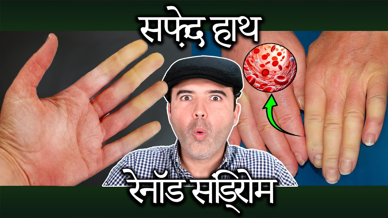 Raynaud Syndrome ya safed/neeli haath (hands) ka ilaaj kaise karein - Kaaran aur Upchaar