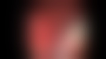 Retrieval of migrated biliary stent