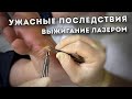 Шрам после выжигания лазером | как правильно удалить мозоль | результат до/после