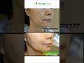 Clim Clinic, FILLERS for WRINKLES!!