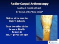 Basic set up and indications for wrist arthroscopy