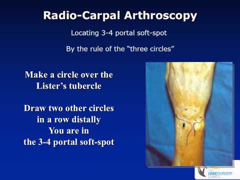 Basic set up and indications for wrist arthroscopy