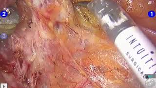 Simple Robot Assisted Hysterectomy