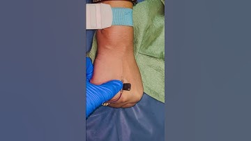 Scalp Vein set insertion technique #shorts #viral #reels #nurse #feed #view #short #injection #gp