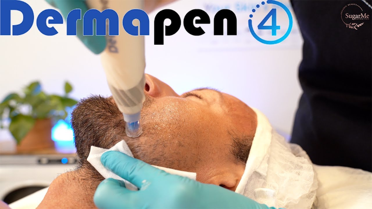 DermaPen Microneedling Anti aging Meso Glide treatment, with a male