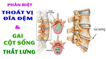 Phân Biệt Bệnh Thoát Vị Đĩa Đệm Và Gai Cột Sống Thắt Lưng