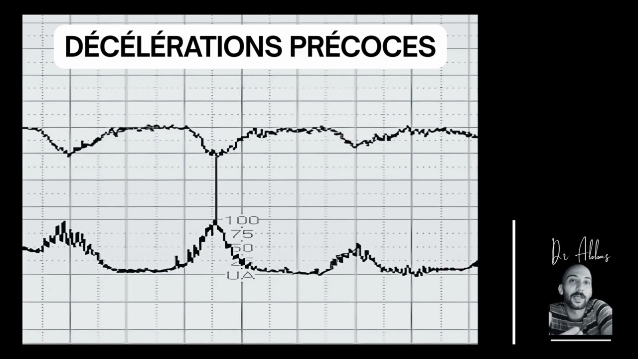 Comment interpréter un ercf : Épisode 15 - Décélérations