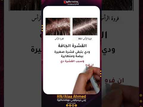 علاج القشرة الجافة